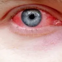 Kenapa, sih, sakit mata mudah menular? | via: deherba.com