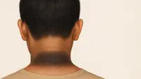 Leher Hitam Tak Selalu karena Kotor tapi Bisa Jadi Gejala Penyakit, Bagaimana Cara Mengenalinya?