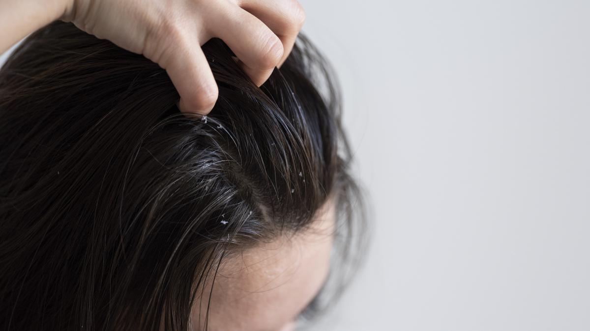 Rambut Gatal dan Berketombe? 5 Hal Ini Bisa Menjadi Penyebabnya!