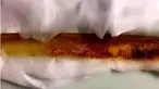 Seorang wanita asal Turki harus menanggung rasa sakit di tenggorokannya. Bukan karena dia sedang flu atau batuk, melainkan karena sisir menyangkut di tenggorokannya. Sisir sepanjang 20 cm itu tertelan setelah wanita yang tidak disebutkan namanya itu henda