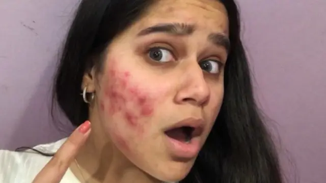Jerawat Parah di Wajah Bisa Hilang Sekejap dengan Makeup Ini