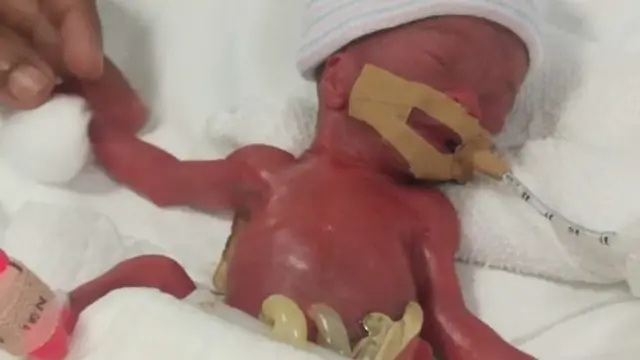 Lahir Prematur, Bayi Ini Jadi Paling Ringan di Dunia dengan Berat 212 Gram