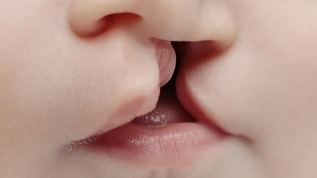 Penyebab Bibir Sumbing Pada Bayi