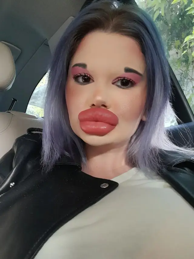 Ingin Tampil Bak Boneka, Wanita Akan Injeksi Bibir Ke 27 Kali Akhir Tahun Ini