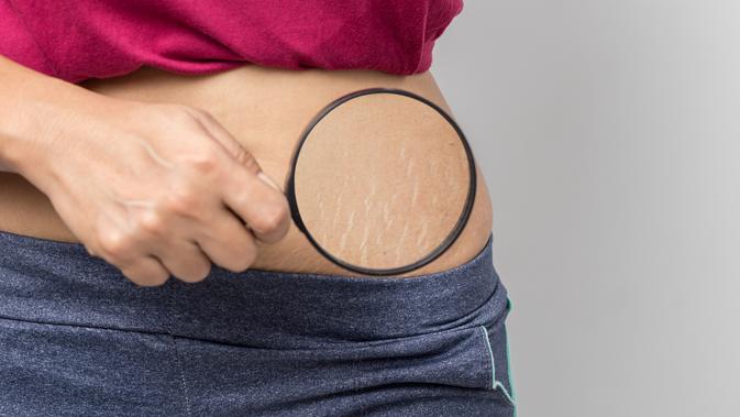 7 Cara Menghilangkan Stretch Mark Setelah Melahirkan Secara Alami Health Liputan6 Com