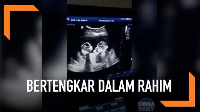 Sebuah video USG viral menunjukkan bayi kembar perempuan bertengkar di dalam rahim. Ini terjadi ketika sang ibu tengah memeriksakan kehamilannya.