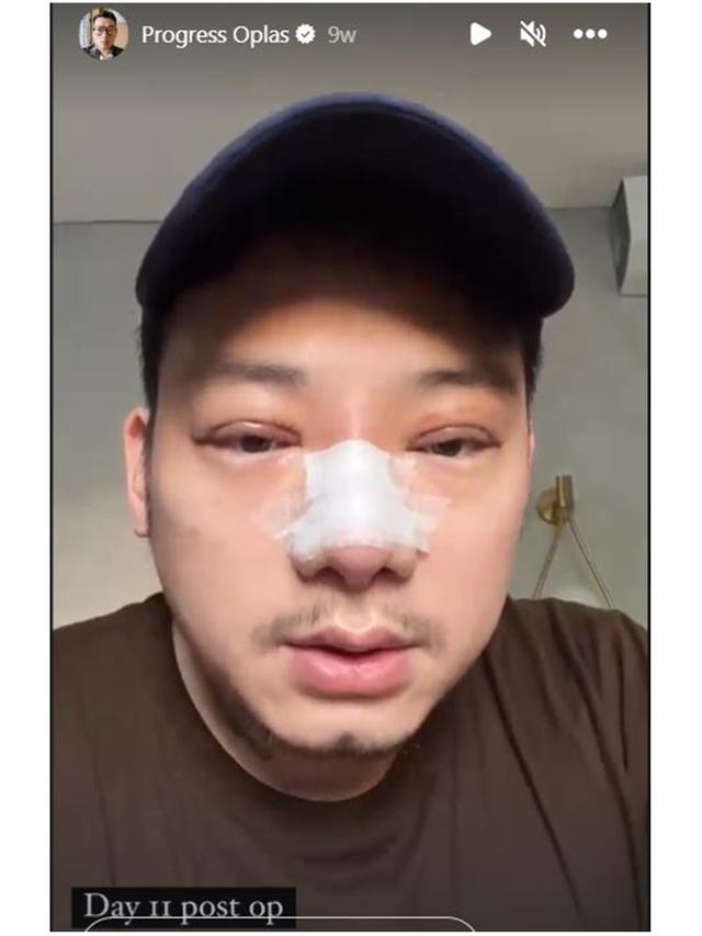 7 Potret Chef William Gozali Jalani Operasi Plastik, Perubahannya Bikin Pangling