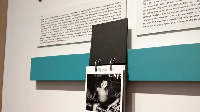 Sebuah foto menunjukkan anak yang terkena cacar api dipajang di museum Bio Farma (Liputan6.com/Giovani Dio Prasasti)