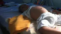 Derita Kelainan Organ, Dafa Butuh Operasi Rekonstruksi Tulang