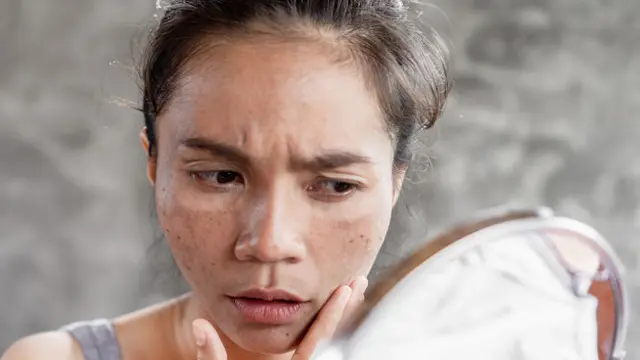 Meredakan Reaksi Kulit yang Terpapar Matahari