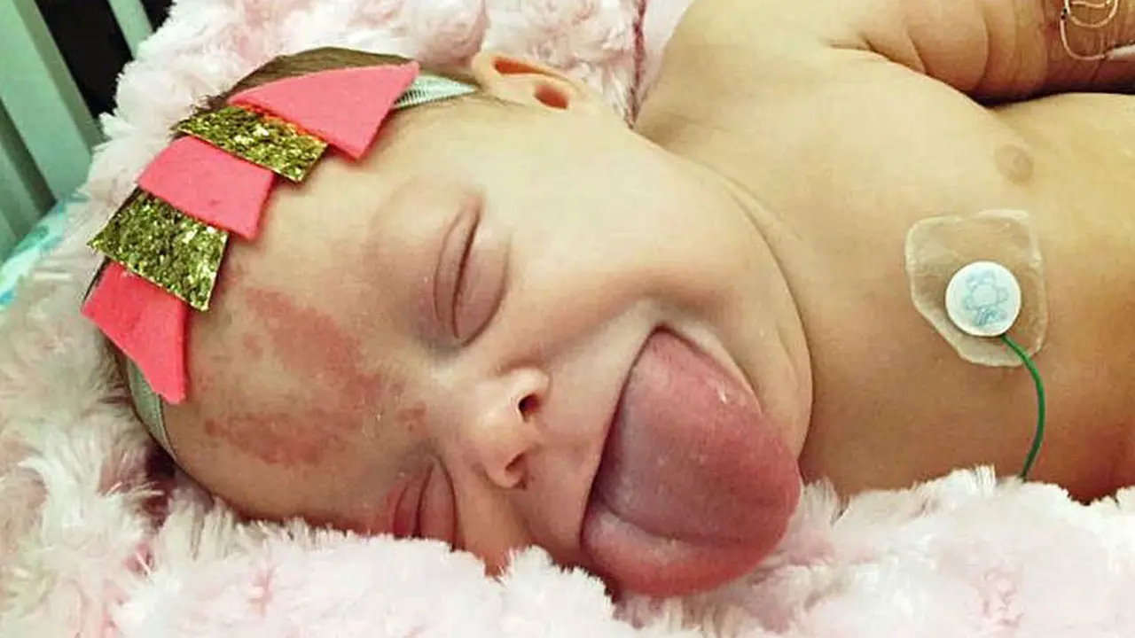Bayi Paisley mengalami kondisi lahir bernama Beckwith Wiedemann Syndrome (BWS). (Foto: Good Housekeeping)