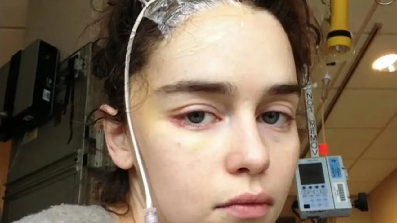 Emilia Clarke saat melakukan perawatan aneurisma otak