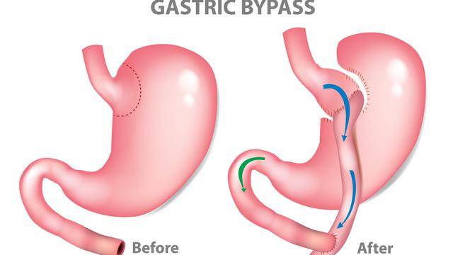 Ilustrasi metode operasi gastric bypass
