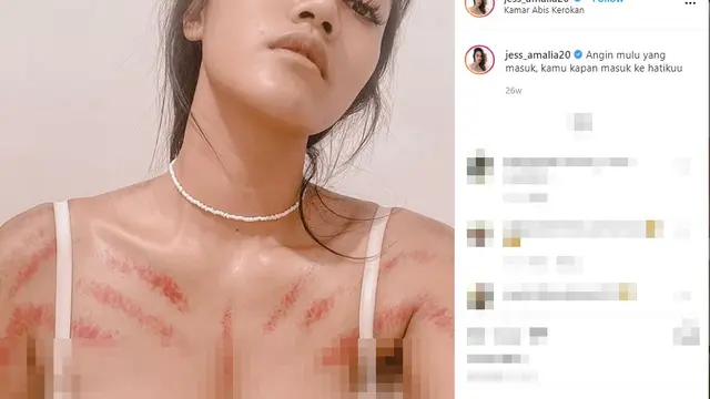 7 Potret Seleb Cantik Pamer Usai Kerokan Ini Tetap Menawan