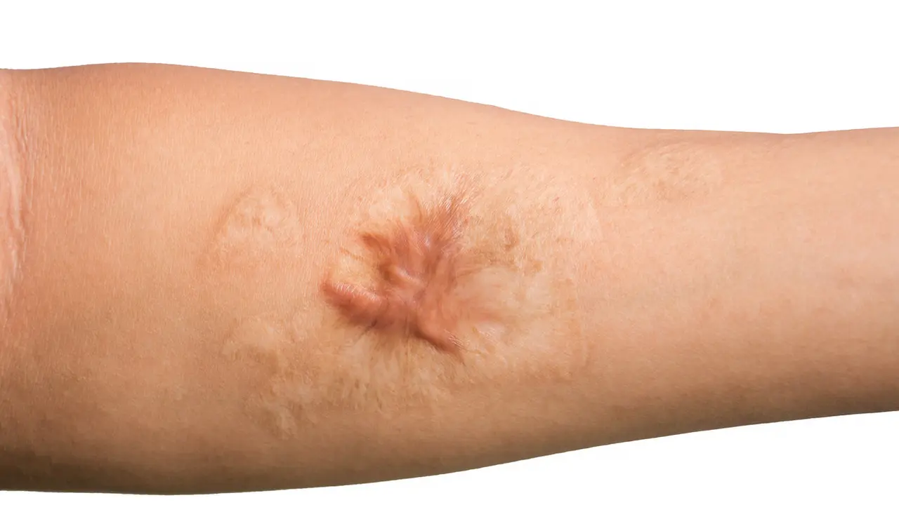 Cara Menghilangkan Keloid