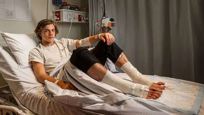 [Bintang] Kaki Remaja Australia Ini Dimakan Ratusan Kutu Laut