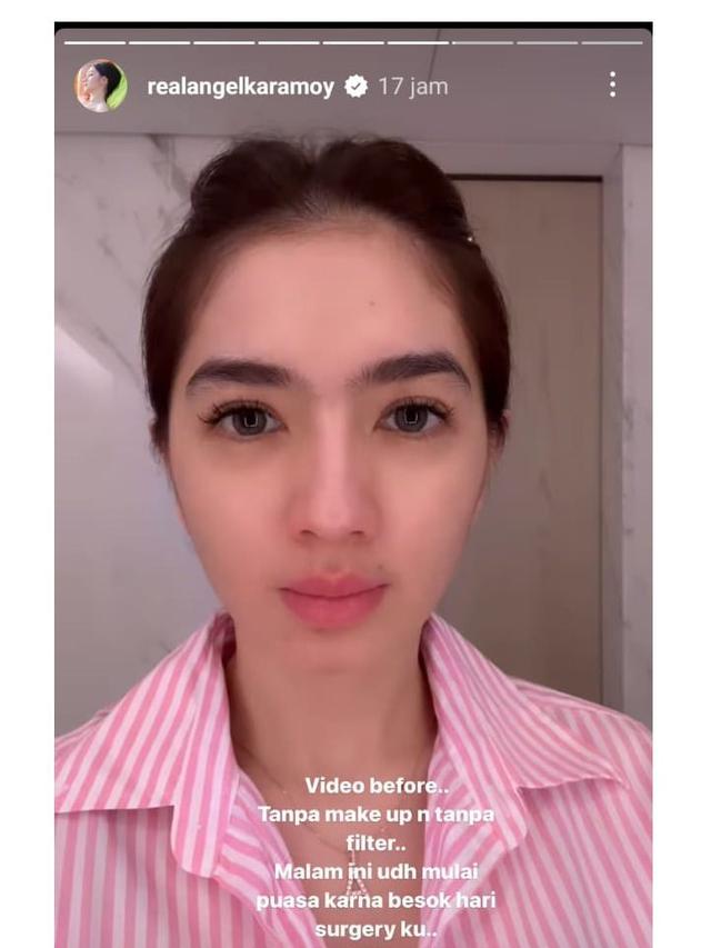 8 Potret Angel Karamoy Jalani Operasi Plastik di Korea Selatan, Curi Perhatian