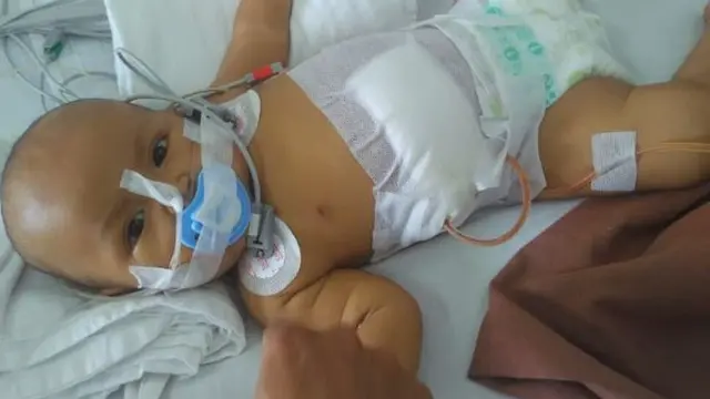 Tiwi, bayi pengidap Atresia Bilier