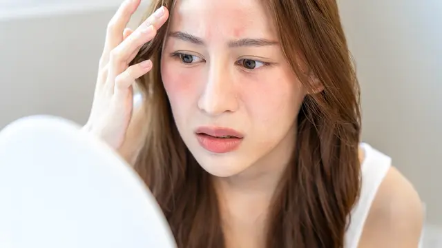 Harus Ekstra Hati-hati, Begini Tips Mengatasi Jerawat yang Muncul pada Ibu Hamil