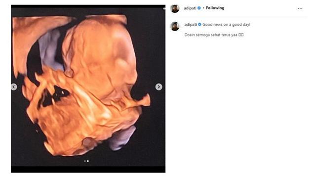 Umumkan Kehamilan, Ini 6 Potret Canti Tachril Istri Adipati Dolken Pamer Baby Bump