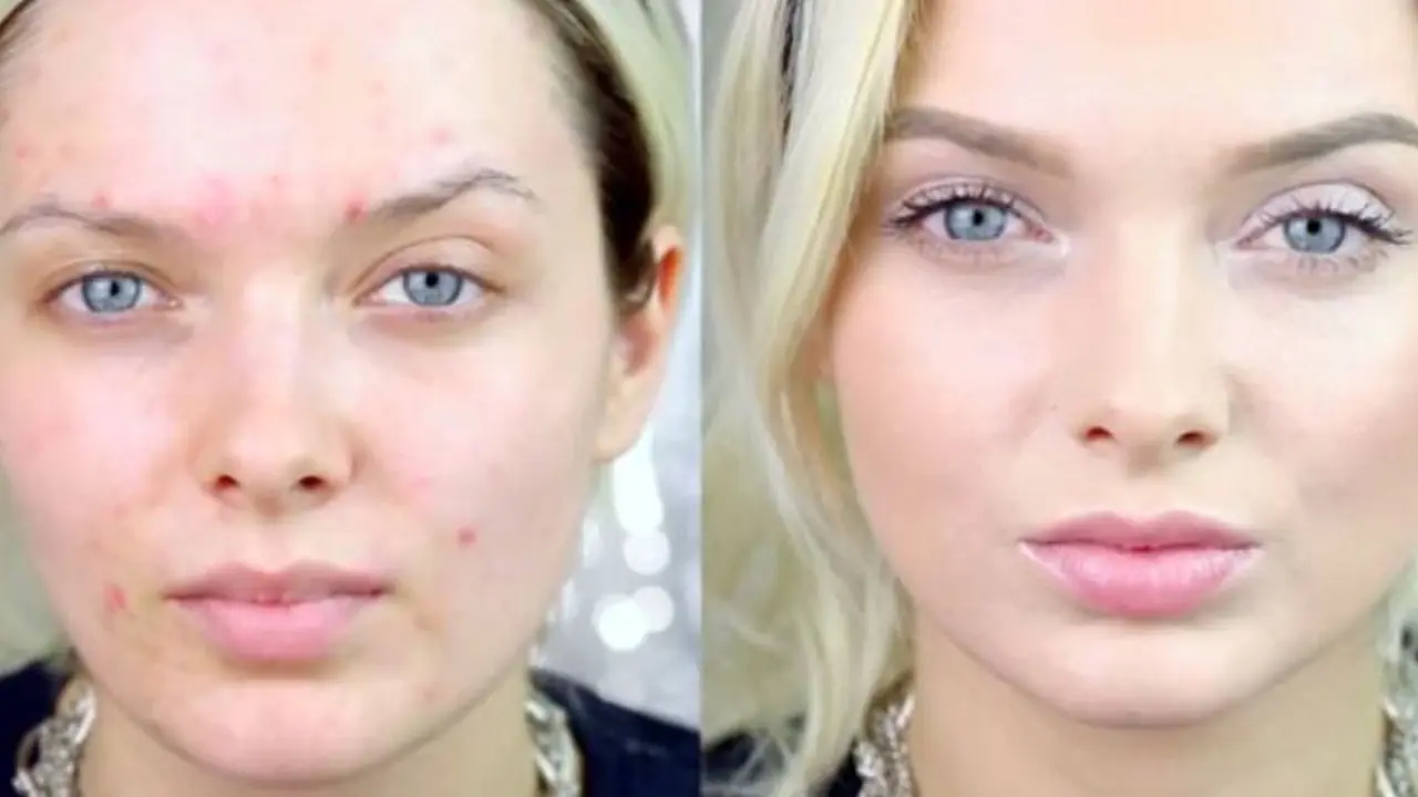 Tips Makeup Super Ampuh Tutupi Bekas Jerawat Membandel