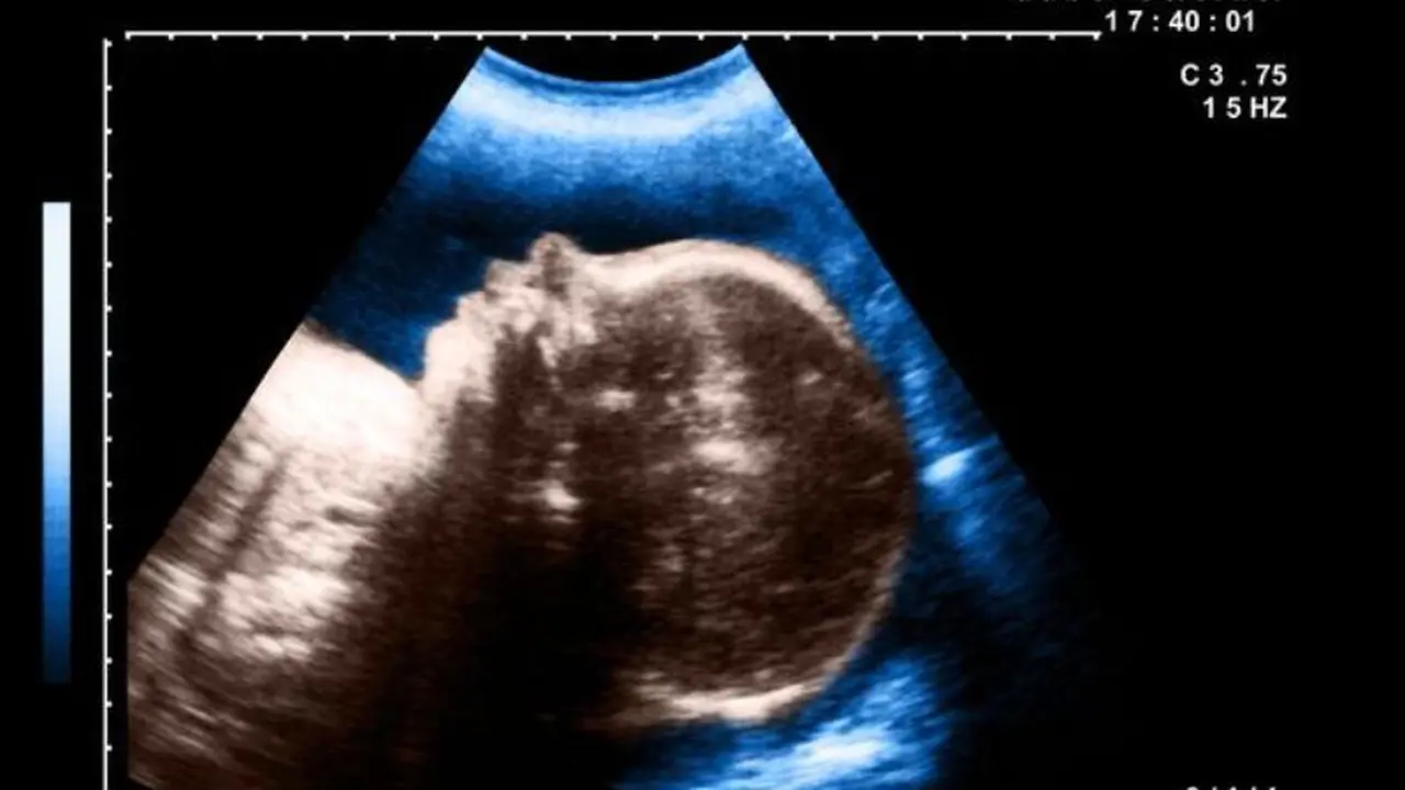 Derita Cyclopia, Bayi Ini Lahir dengan Satu Mata