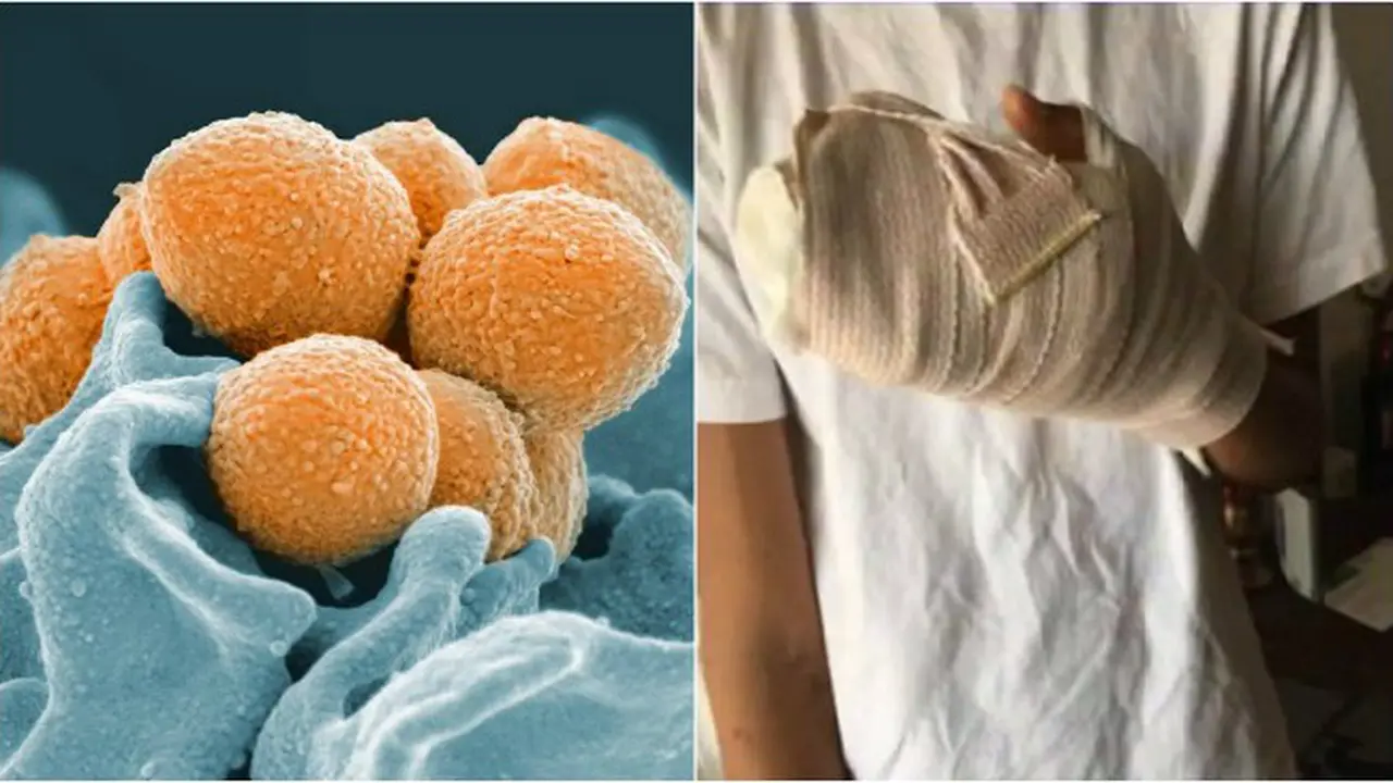 Infeksi strep A (0)