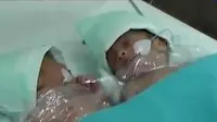Bayi kembar siam dempet perut ini dinyatakan kritis dan dapat mengancam jiwanya.