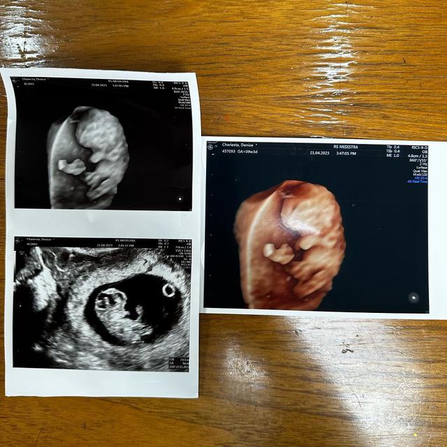 7 Potret Denise Chariesta Saat Periksa Kehamilan, Banjir Kritikan Netizen