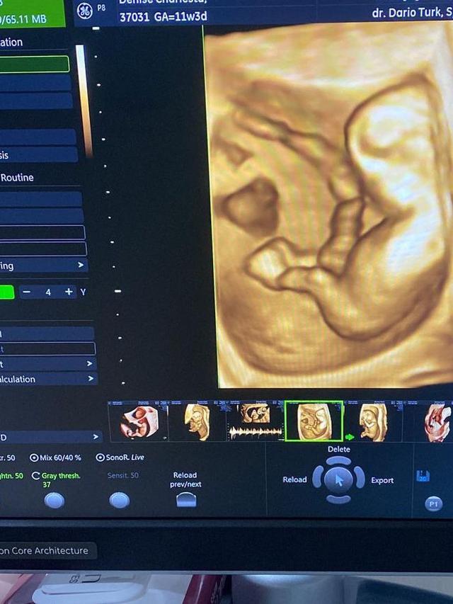 7 Potret Denise Chariesta Saat Periksa Kehamilan, Banjir Kritikan Netizen