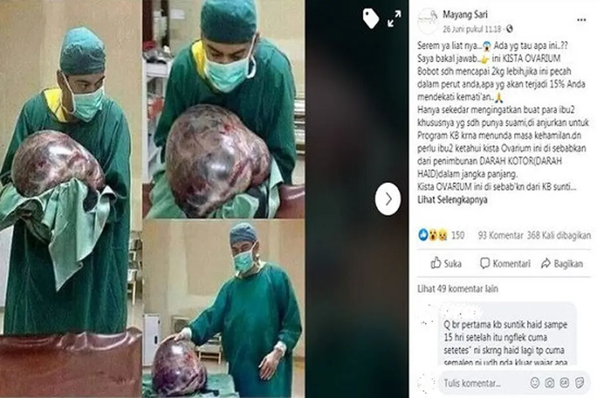Gambar Tangkapan Layar Foto Kista Ovarium