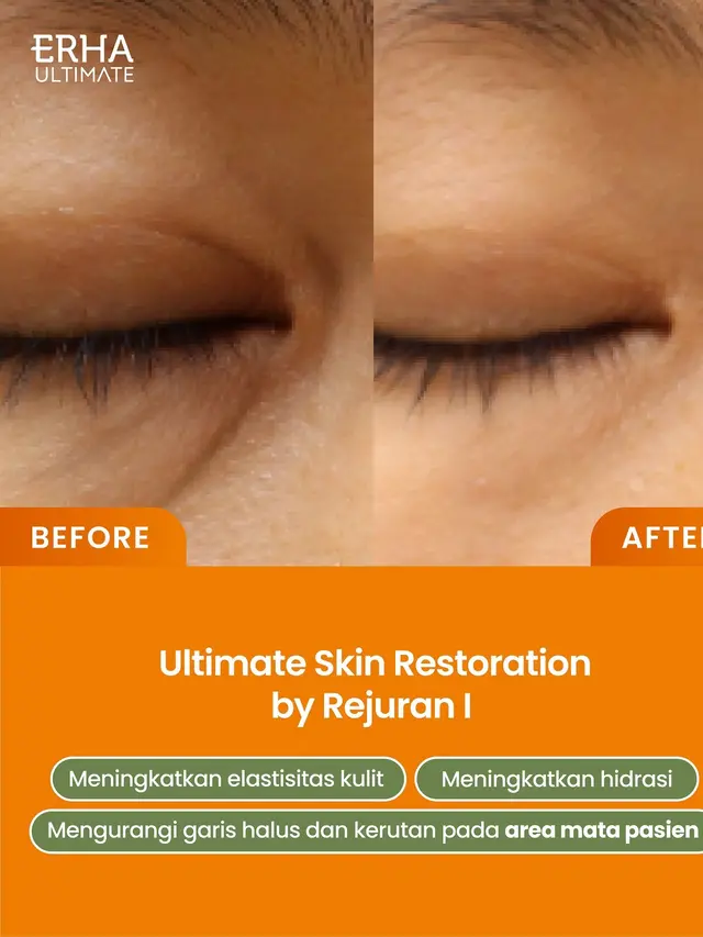 Perawatan Wajah Rejuran Lagi Hits di Korea, Mana Jenis Treatment yang Ingin Kamu Coba?