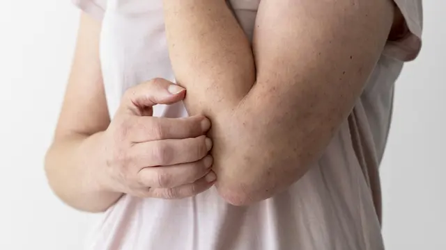 Psoriasis Beda dengan Eczema Meski Kerap Tunjukkan Gejala yang Mirip