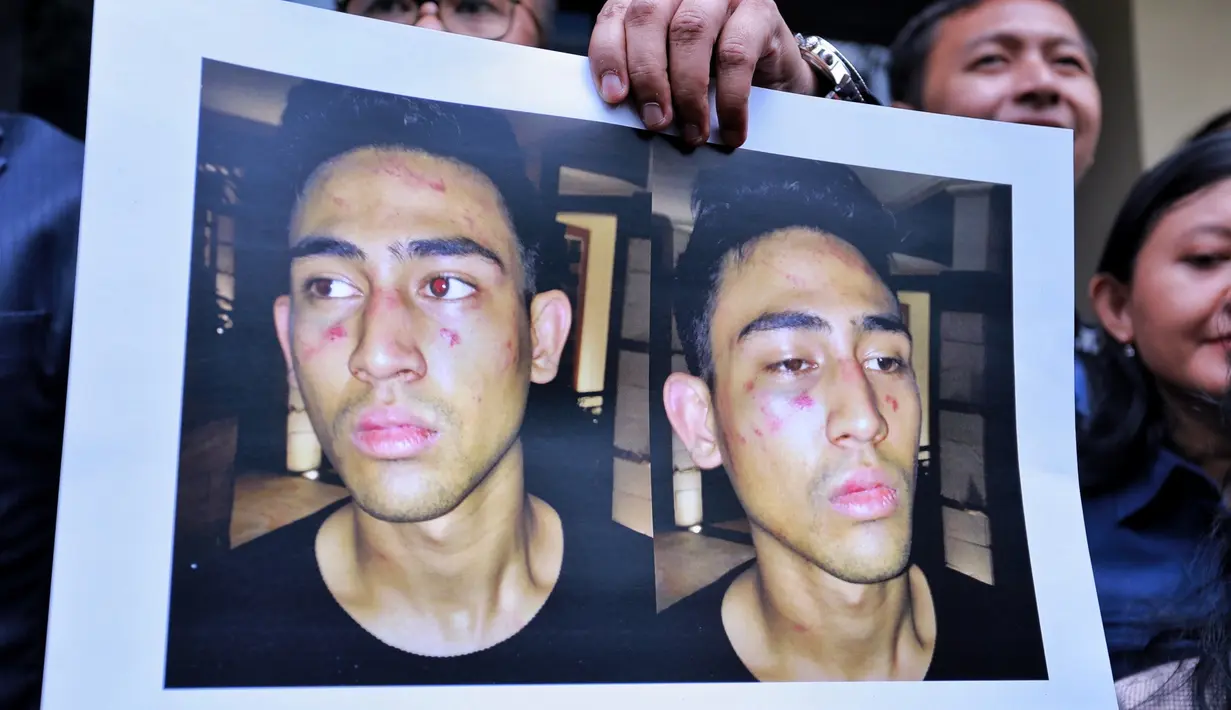 "Pada saat kami saya bersama lawyer dan tim Jatanras mau masuk ke gedung saya lihat putra saya turun bersama beberapa orang. Begitu saya dekatin kondisi putra saya sudah babak belur," pungkas Jeremy Thomas. (Adrian Putra/Bintang.com)