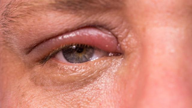 12 Penyebab Mata Merah Perih yang Sering Terjadi dan Cara Mengatasinya