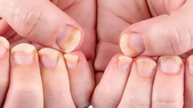 Gejala Awal Kuku Berjamur yang Harus Diwaspadai