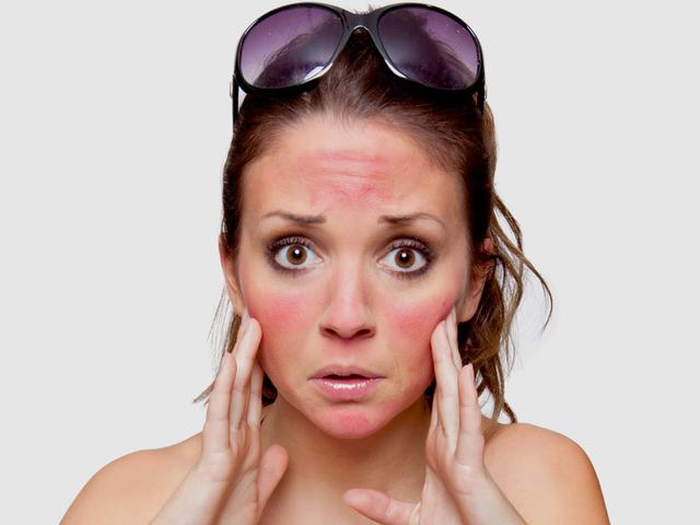 Gejala Alergi Sinar Matahari Dan Cara Mengatasinya Yang Tepat Hot Liputan6 Com