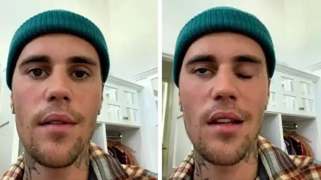 Justin Bieber alami Ramsay Hunt Syndrome yang membuat saraf wajah lumpuh sebelah. (Foto: Potongan layar Instagram @justinbieber)