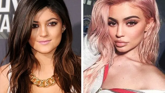 artis sebelum vs setelah operasi plastik