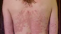 Psoriasis eritrodermik (sumber: wikipedia)