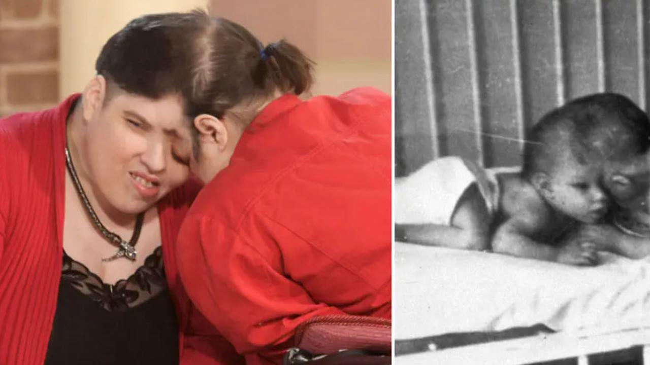 Kembar siam Lori dan George meninggal dunia pada 7 April. (Tangkapan layar: guinnessworldrecords)