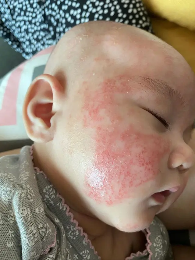 7 Potret Perjuangan Mona Ratuliu Rawat Anak yang Idap Dermatitis Atopik