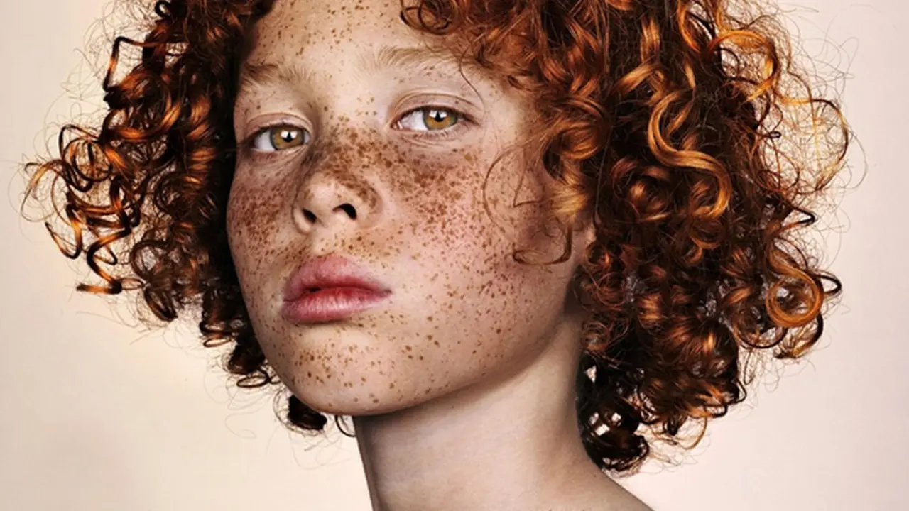 Freckles Muncul di Wajah Karena Alasan Ilmiah, Simak di Sini