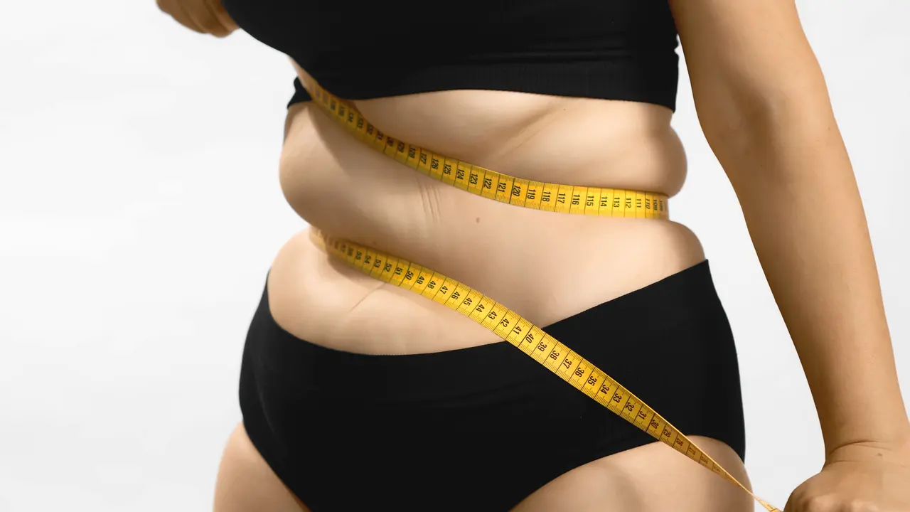 Lipoedema sering dianggap sebagai obesitas padahal keduanya berbeda