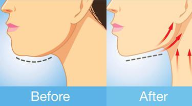 7 Cara Efektif Menghilangkan Dagu Bergelambir Beauty Fimela Com