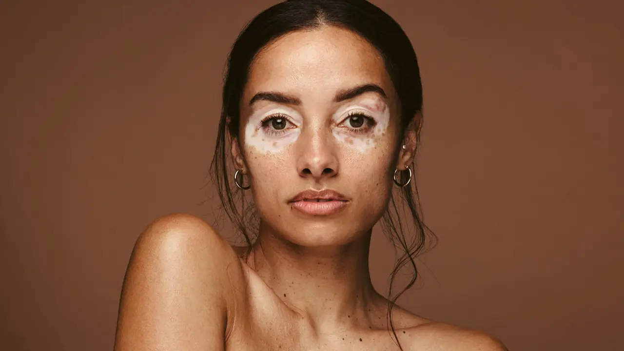 kulit vitiligo