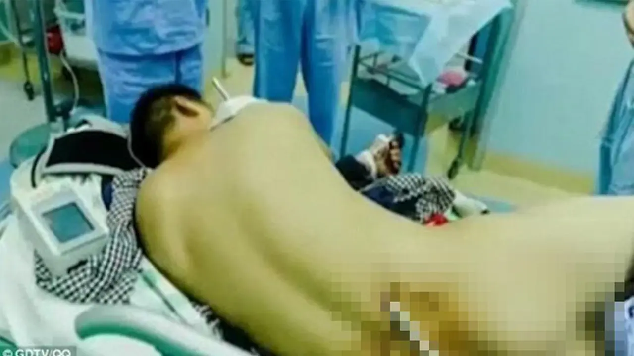 Kuli Bangunan Bertahan Hidup, Meski Besi 2 Meter Menembus Tubuh