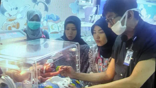 Bayi Kembar Siam