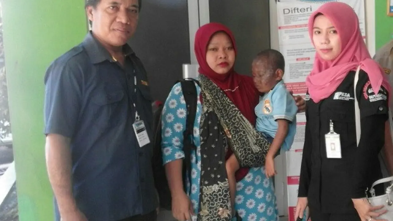 Derita Penyakit Langka, Sekujur Tubuh Balita Asal Batang Melepuh