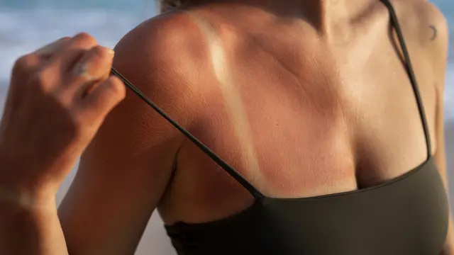 1. Segera Dinginkan Kulit